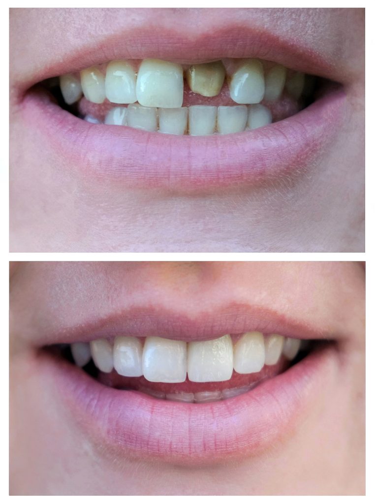 Smiling woman with a bad tooth before and after treatment.